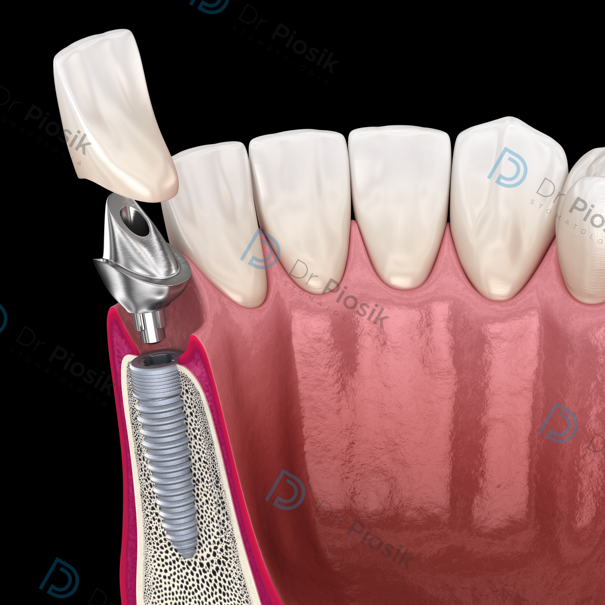Schemat korony na implancie