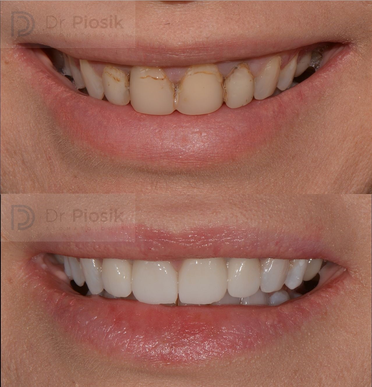 Licówki i wybielanie