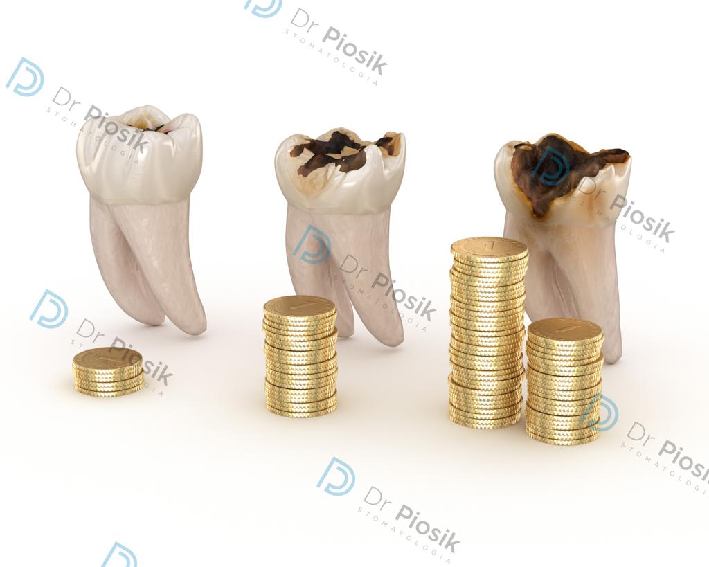 Koszty leczenia zęba