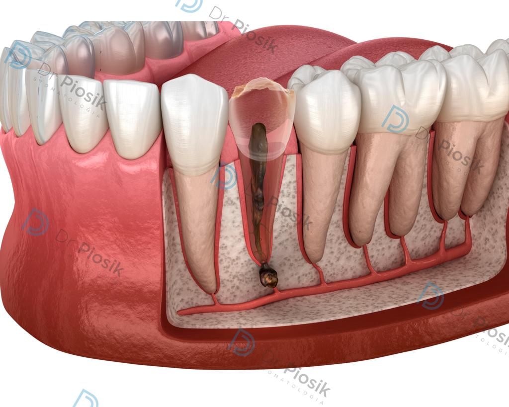 Zmiana okołowierzchołkowa w kości