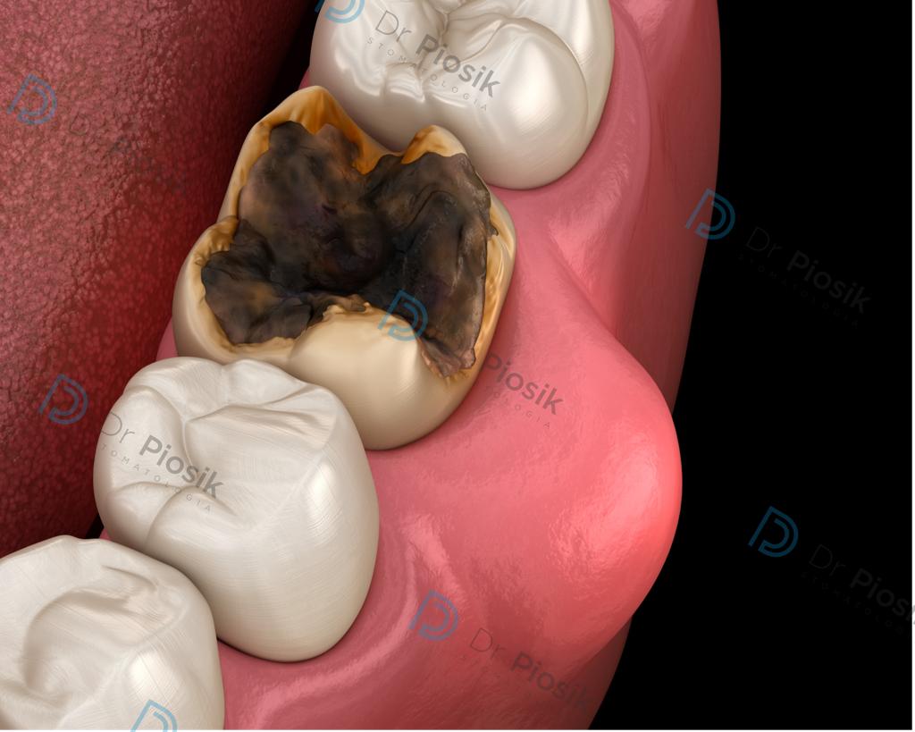 Ropień przebijający przez śluzówkę