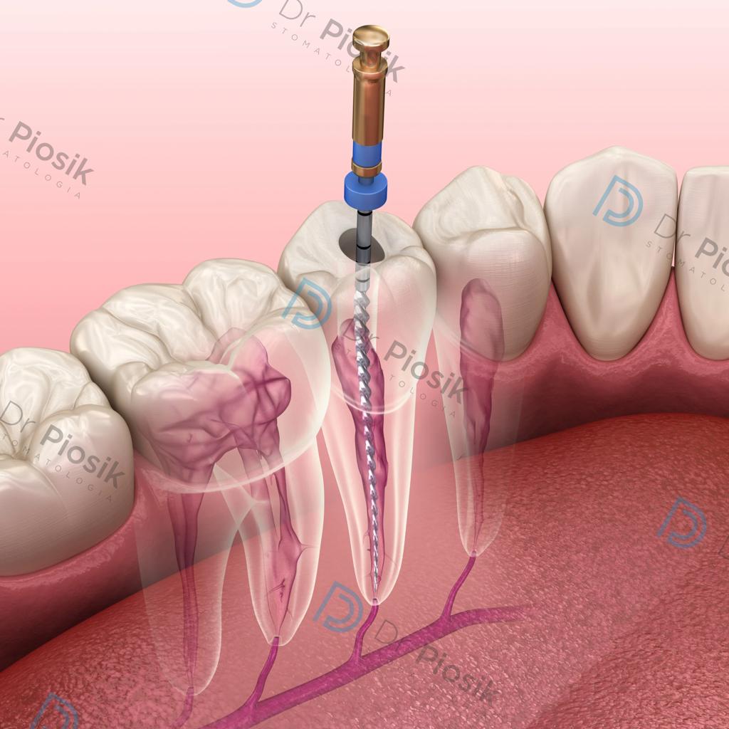 Oczyszczenie endodontyczne